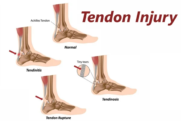 Tendinitis