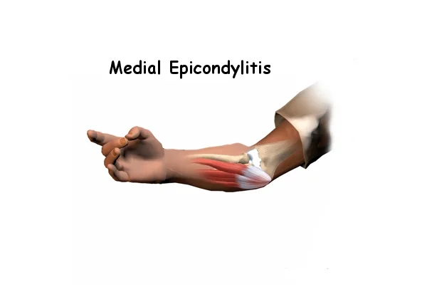 Golfers Elbow