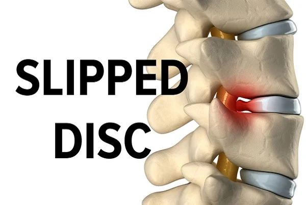 Slipped Disc