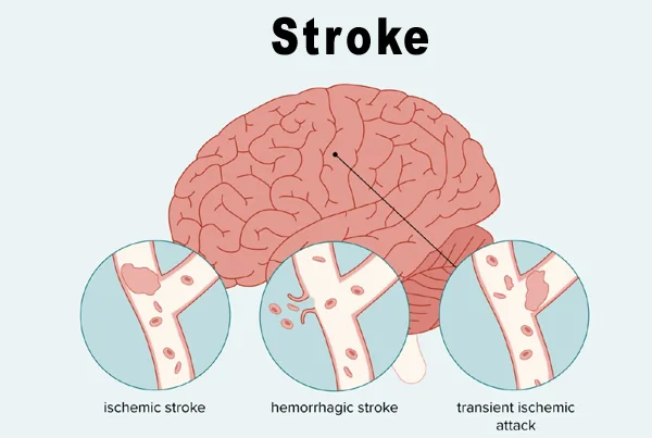 Brain Stroke