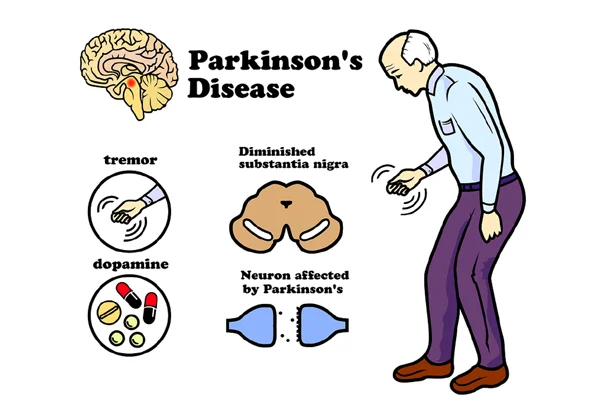 Parkinsons  Disease