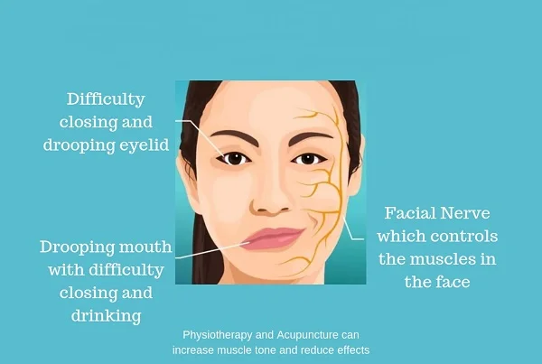 Bells Palsy
