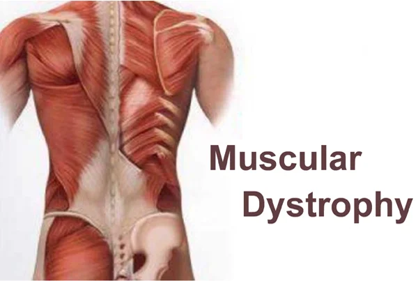 Muscular dystrophy