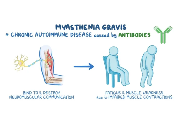 Myasthenia Gravis