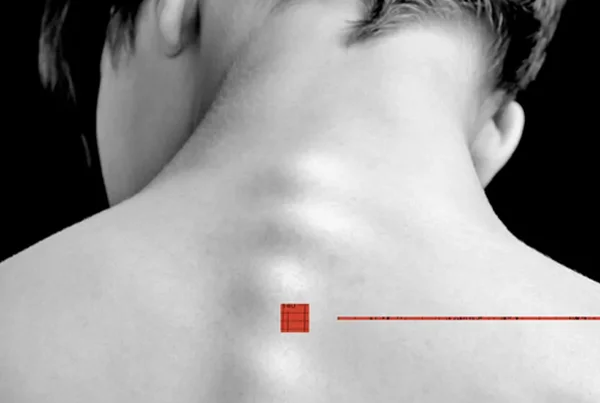 Radiculopathy