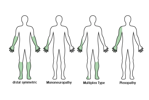 Polyneuropathy