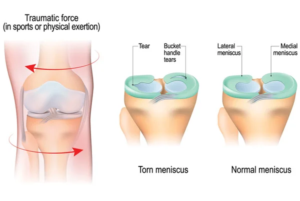Meniscus Injury
