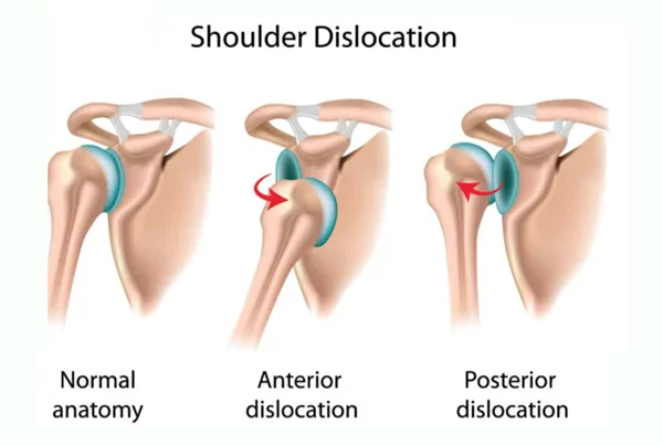 Shoulder Dislocation